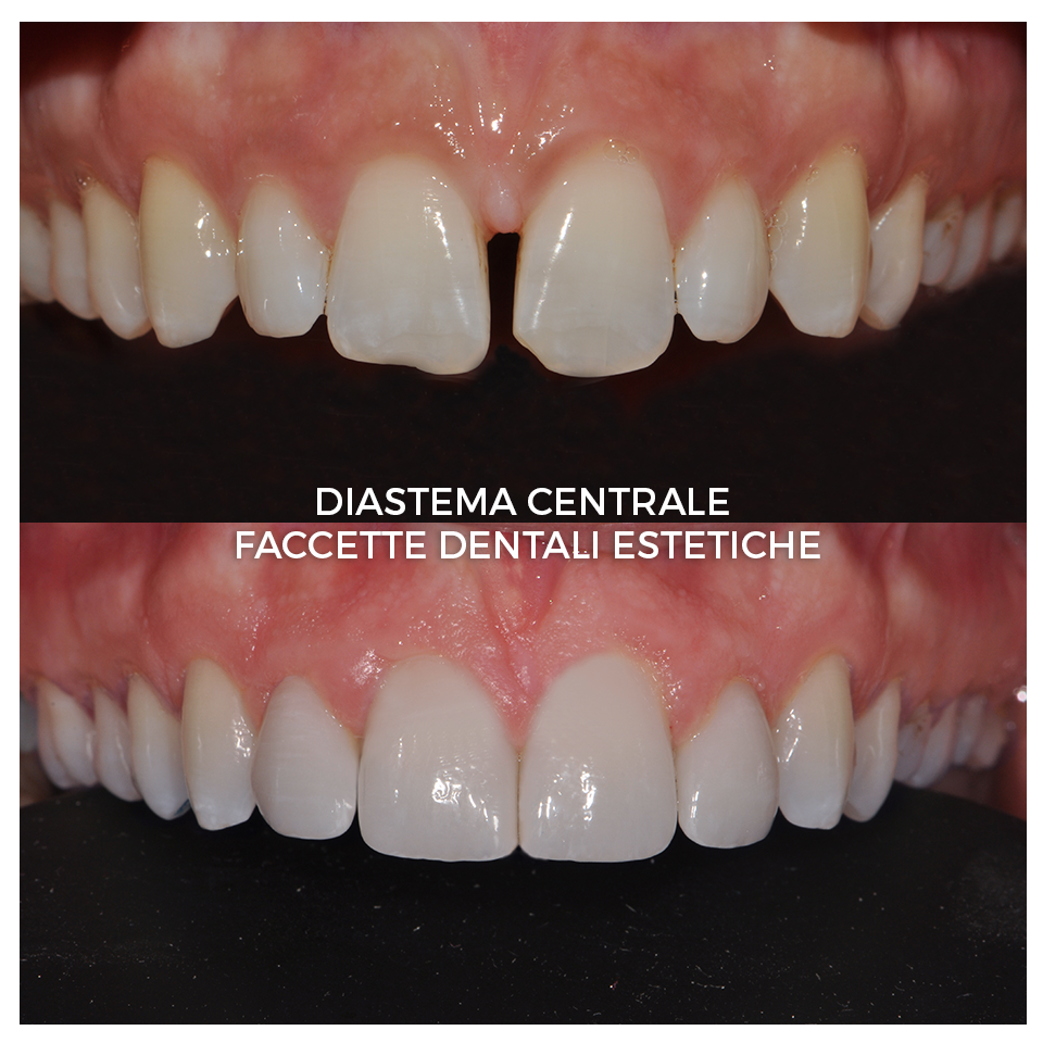 Diastema