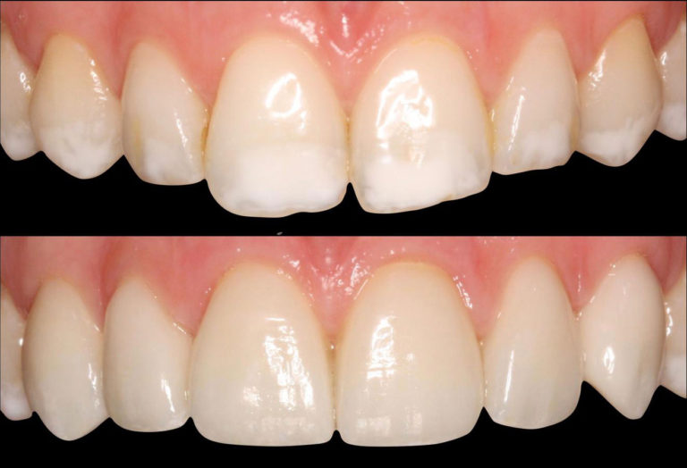 frtature dei denti