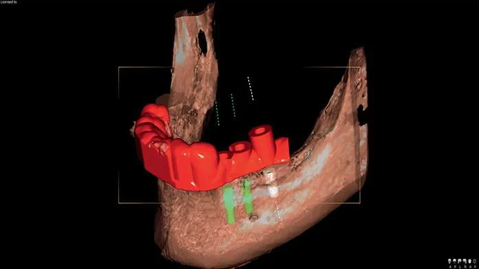 Guide-chirurgical2