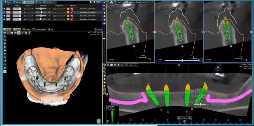 Software implantologia