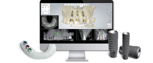 implantologia-computer-assistita-4